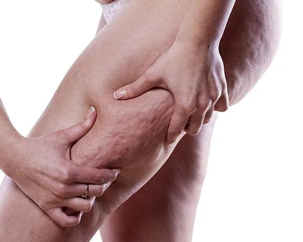 Pernas de mulher com sinais de lipedema (imagem ilustrativa)